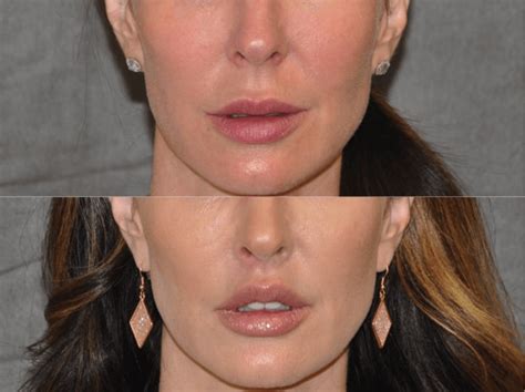 philtrum lower lip lift.